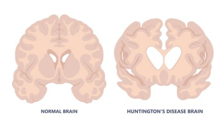 A graphic displaying a brain with and without Huntington's disease.